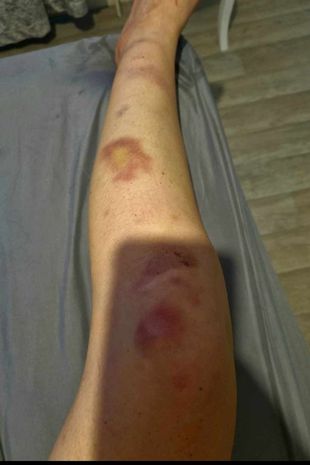 一名女子在对暗网毒品上瘾9年后发出警告