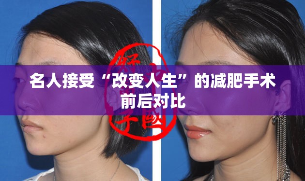 名人接受“改变人生”的减肥手术前后对比