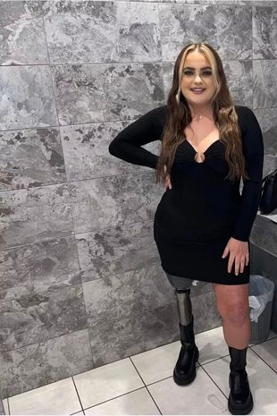 一名年轻的妈妈在时速81英里的宝马肇事逃逸事件中被迫截肢，赢得了100万英镑的赔偿